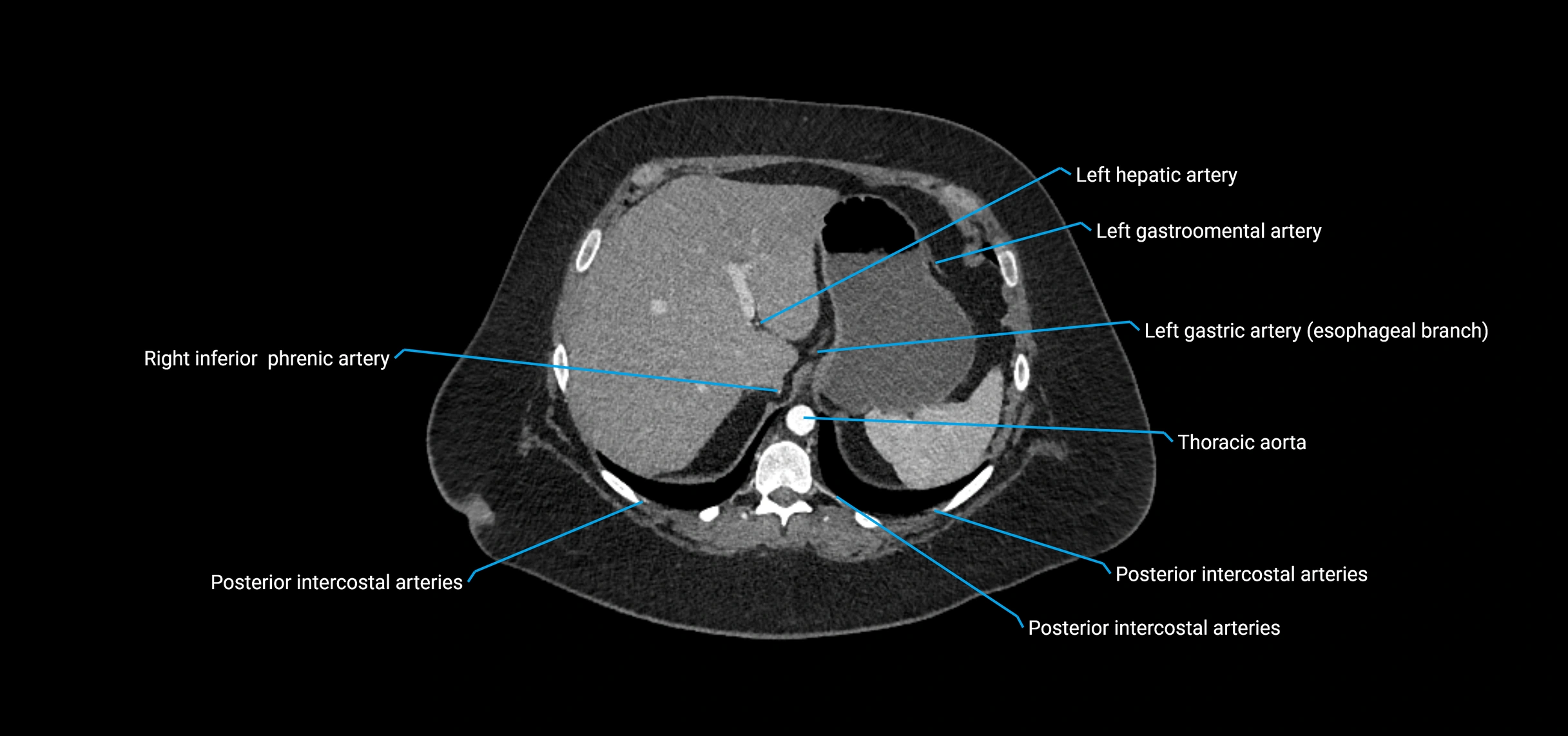 CTA abdomen axial cross sectional anatomy labelled image_34 (2).webp